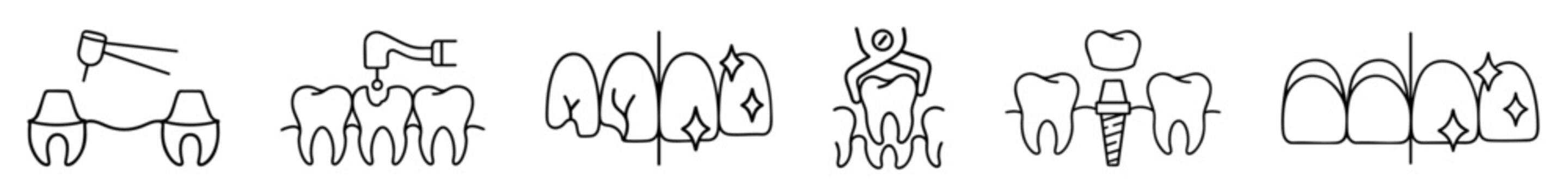 Dental treatment set &mdash; bridge preparation with adjacent teeth grinding for missing tooth replacement, root canal filling procedure, professional teeth cleaning before and after plaque removal , tooth 