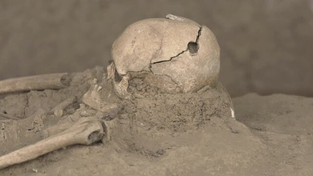 Ancient trepanned human skull with burr hole surgery &ndash; archaeological evidence of early cranial intervention