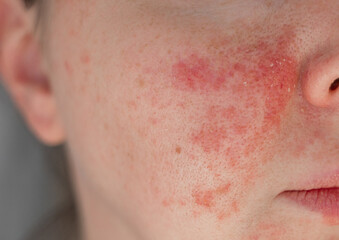 Close-up of a young womans face with visible skin irritation and redness. Inflamed, dry, and...