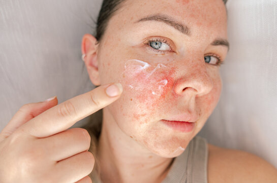 woman applying cream to irritated and inflamed facial skin with visible redness. Sensitive and problematic skin with dryness and imperfections. Dermatology, skincare treatment, and self-care concept.