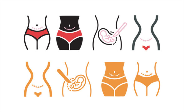 Printcesarean section icon with scar, line and solid design, Woman cares for her body after childbirth by applying medical ointment to surgical incision. Postpartum recovery process and skin care for 