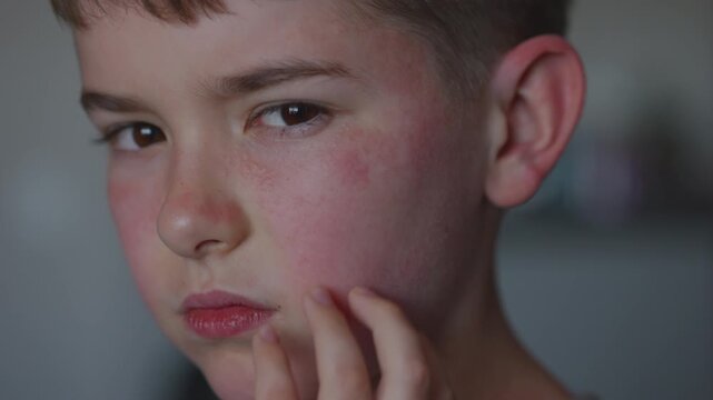 Boy Having Allergic Reaction on Skin to Food.	Boy Has Dry Red Skin and Scratching Her Face. Child Scratches Atopic Skin. Dermatitis, Diathesis, Allergy on Child Body and Face. Irritation and Pruritus.