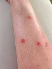 Fototapeta premium Close-up of bed bug bites on human leg. Allergic reaction to bed bug bites on skin. Multiple red, inflamed bites on lower leg from an insect infestation.