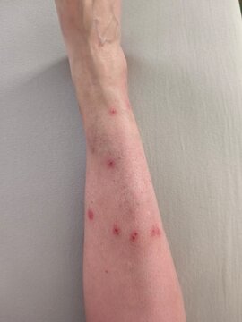Close-up of bed bug bites on human leg.
Allergic reaction to bed bug bites on skin.
Multiple red, inflamed bites on lower leg from an insect infestation.