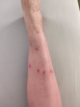 Close-up of bed bug bites on human leg.  
Allergic reaction to bed bug bites on skin.