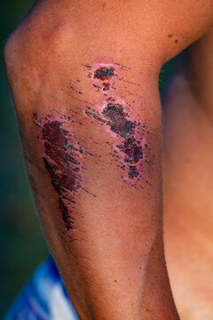 Closeup of a scraped on an elbow with dried blood and healing scabs from a motorcycle accident outdoors, highlighting minor injury first aid care and skin recovery concept