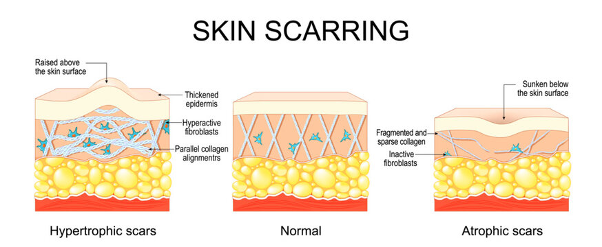 Skin scarring. Comparison of Normal skin surface, Hypertrophic scars and Atrophic scars