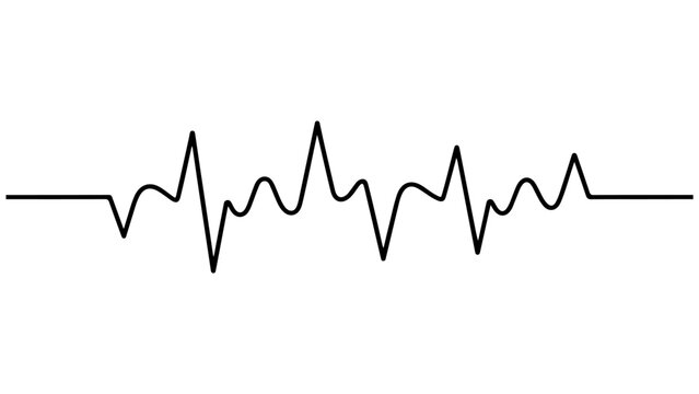 Electrocardiogram showing abnormal heart rhythm with irregular peaks and intervals
