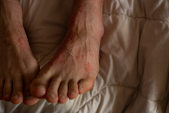 Male feet skin allergic reaction to fever. Urticaria vasculitis disease causes itchy wheals. Swollen varicose veins. Angioedema