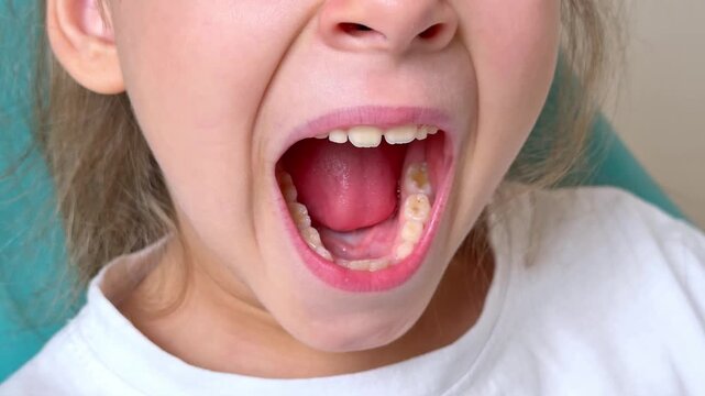 Close-up of little girl opening her mouth wide to the doctor to show her throat. Child is sitting with wide open mouth, with a tongue stuck out, clear view on the uvula and the soft palate