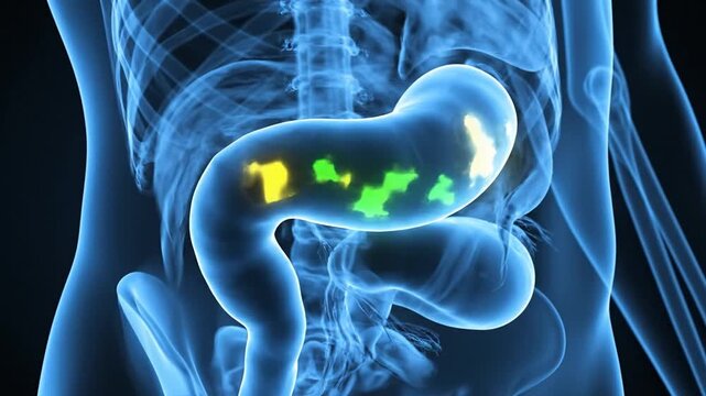 3D medical animation. Translucent human anatomy showing stomach and intestines. Glowing green and yellow spots indicate bacteria or infection in the stomach. X-ray style visualization.