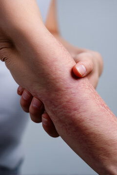 Close up photo of a red rash or an allergic reaction on an arm.