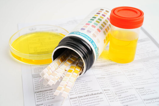 Urinalysis, urine cup with reagent strip pH paper test and comparison chart in laboratory.
