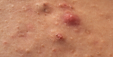 Fototapeta premium Close up acne on skin. Dermatology concept with acne skin pores. Skin rash texture with acne. Irritated acne skin.