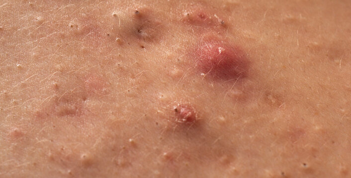 Close up acne on skin. Dermatology concept with acne skin pores. Skin rash texture with acne. Irritated acne skin.