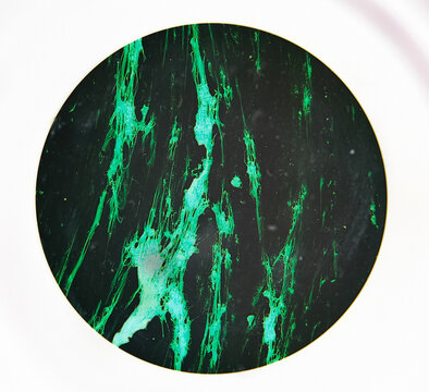 Microscopic footage of urethral smear for Gram stain. No gram negative intra or extracellular diplococci are seen.
