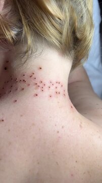 Process of removing mole using laser on woman's neck by surgeon, burning skin, closeup view. Cosmetic treatment in beauty clinic. Surgery medical concept. Removing birthmark surgical procedure