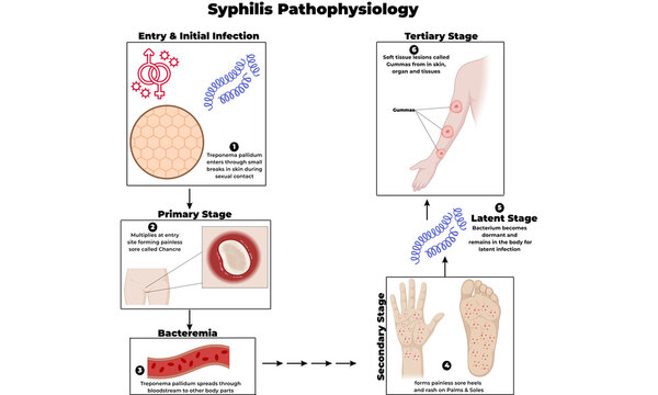 Syphilis Pathophysiology &ndash; Treponema pallidum Infection and Human Body Effects Illustration