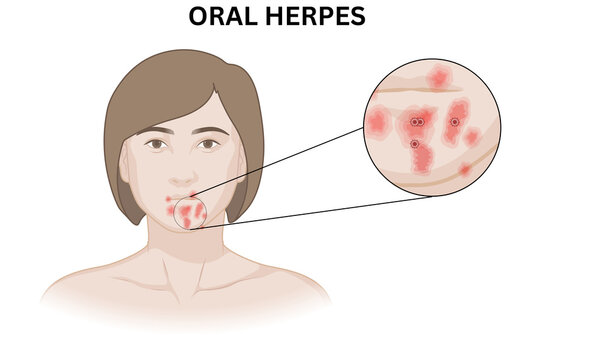 Oral Herpes (HSV-1) Medical Illustration &ndash; Human Mouth Infection Diagram
