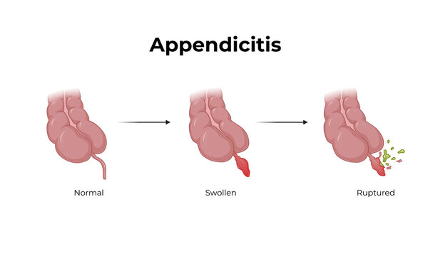 Appendicitis Medical Illustration &ndash; Inflamed Appendix and Abdominal Anatomy Diagram