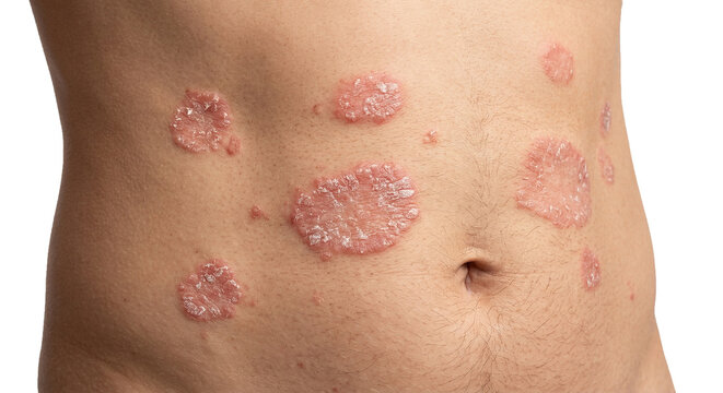 Close up of plaque psoriasis skin disease  on human abdomen or stomach 