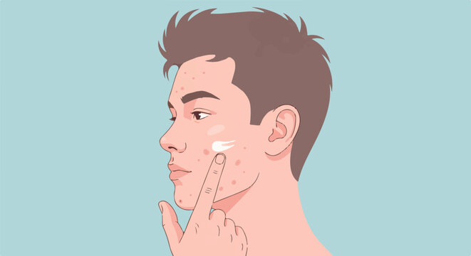 Close-up profile of a young man applying cream to his acne-prone skin