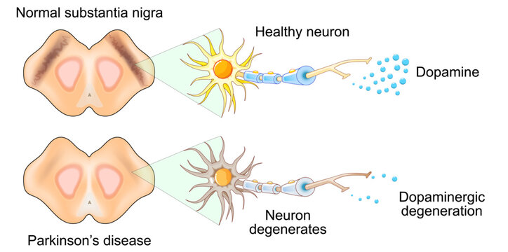 Parkinsons disease.&nbsp;Substantia nigra, Neuron degeneration and Dopamine level