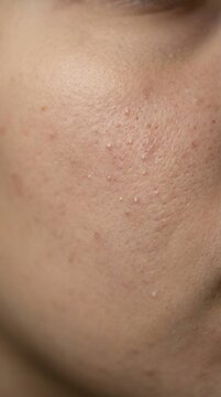 Extreme close up of human cheek with visible pores and whiteheads. Depicts skin irritation and texture issues. Ideal for dermatology and skincare marketing materials.