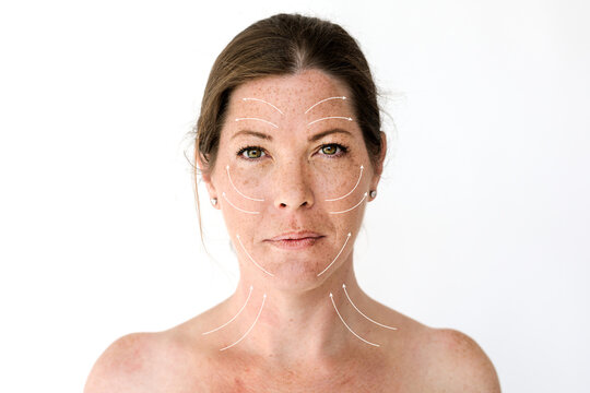 Facial rejuvenation lines diagram photo