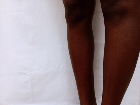 Side view of African adult with Osteomalacia or bowlegs on white background. Condition caused by vitamin D, calcium or phosphate deficiency in human. Disorder of bone softening in two legs.