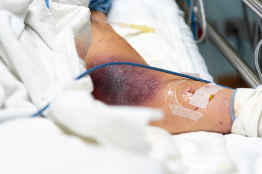 Close up of patient arm with severe bruising and IV line in hospital showing injury medical treatment pain condition and healthcare care concept