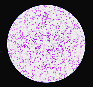 Chronic lymphoproliferative disease. Mature looking lymphocytes, scant cytoplasm, condensed chromatin, frequent smudge cells.