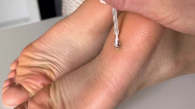Applying salicylic acid treatment to a plantar wart on the heel using a brush applicator