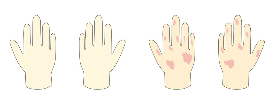 きれいな手と荒れた手のイメージイラスト