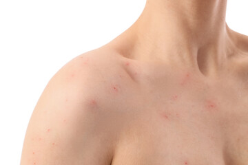 Naklejka premium Female body with acne problem on white background