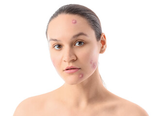 Fototapeta premium Young woman with acne problem on white background