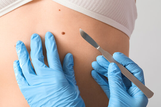 Surgeon with scalpel and mole on woman's belly against light background, closeup