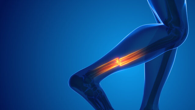 Broken leg bone pain medical concept