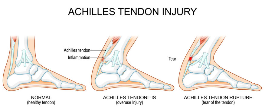 Achilles tendon injury. Healthy anatomy and the progression from tendinitis to rupture