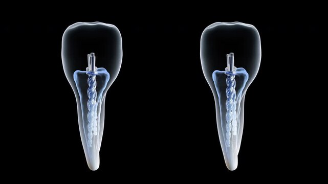 3d tooth animation. Isolated rotating 3d tooth model. filling and pin in the tooth. Soaring beautiful white dental 3d rendering.