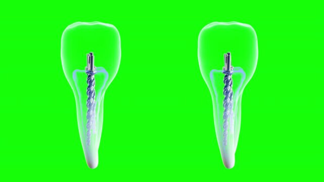 3d tooth green screen animation. Isolated rotating 3d tooth model. filling and pin in the tooth. Soaring beautiful white dental 3d rendering.