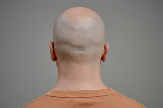 Bald head with hair loss in studio back view wellness concept