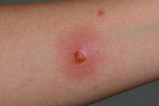 Close-up of a painful red inflamed skin lesion with a blister and pus