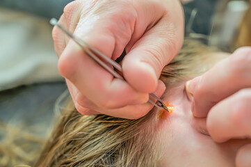 Carefully removing a tick with tweezers that has bitten a child's ear.