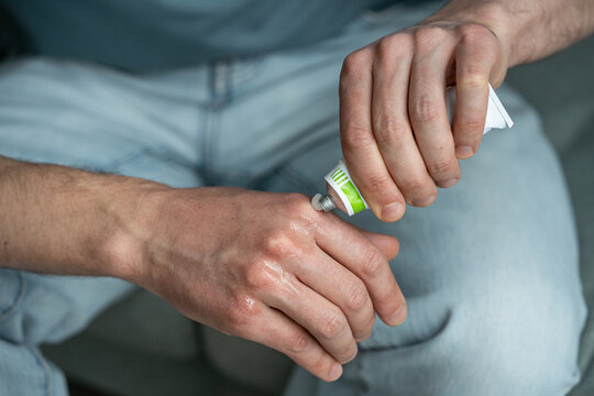 Male applying natural cosmetic moisturizing cream from tube on dry hands skin to cure cracks and redness after frostbite, winter season disease, cold weather and low temperature dangerous for skin.