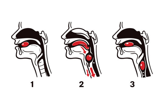 Illustration of tonsil and adenoid removal process in three stages Vector