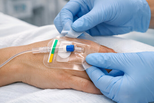 Close-up of IV cannula insertion on patient hand by medical professional, highlighting healthcare treatment, hospital care, sterile procedure, and patient safety.