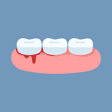Illustration of the problem of bleeding gums. Dentistry