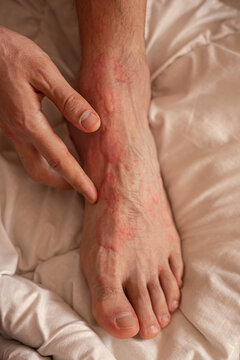 Male feet skin allergic reaction to fever. Urticaria vasculitis disease causes itchy wheals. Swollen red skin dots.Angioedema on feet.