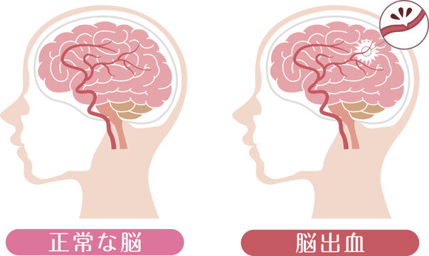 Cerebral hemorrhage comparison with normal brain medical illustration	
